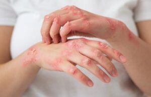 Cacar Monyet Mulai Masuk ke Indonesia